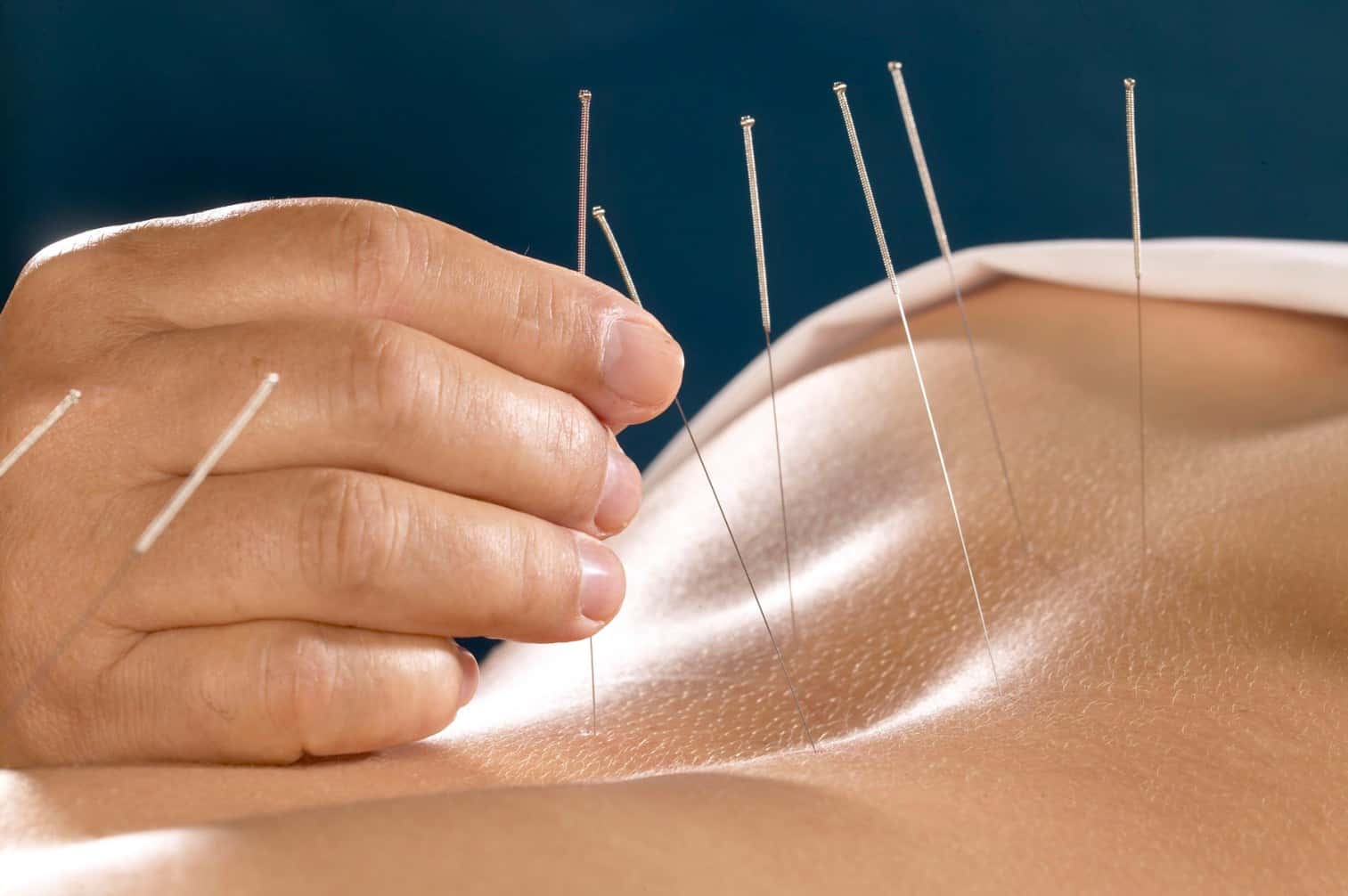  dry needling Melbourne