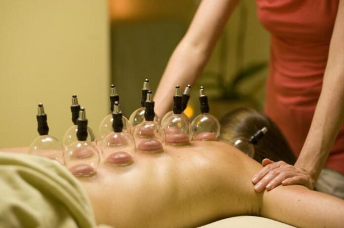 cupping therapy Melbourne