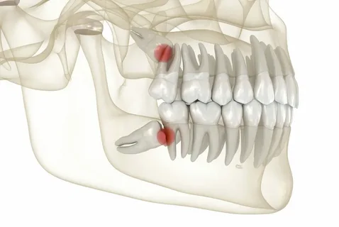  Wisdom teeth removal Newtown
